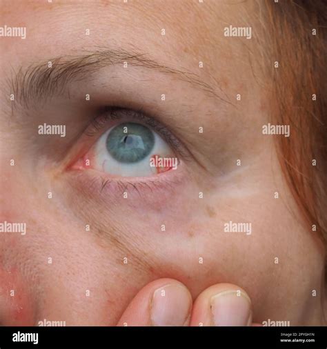 Subconjunctival hemorrhage or subconjunctival bleeding, hyposhagmus ...