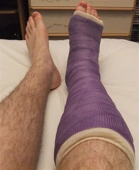 Cast Colors For Broken Legs