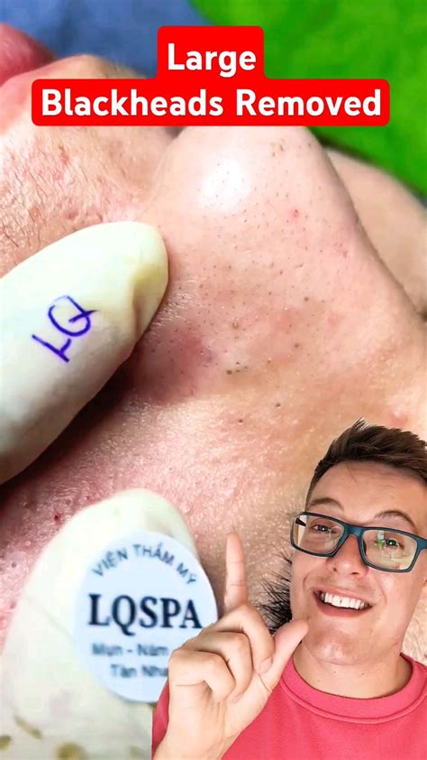 CRAZY BLACKHEAD REMOVAL - Huge Blackheads On Nose #shorts - YouTube