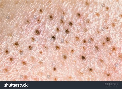 Black Bumps On Skin