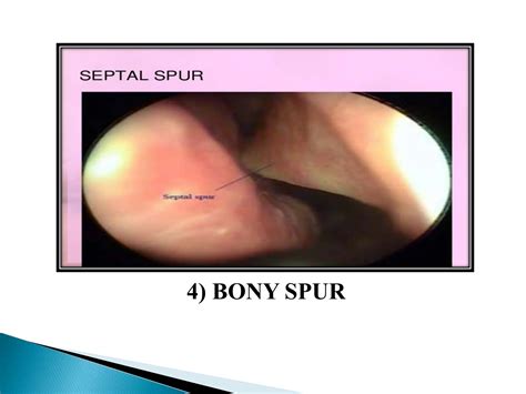 DEVIATED NASAL SEPTUM BY BHUMIKA.G.THAKOR | PPTX