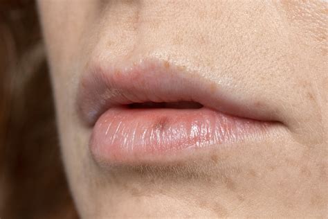Small bumps on lips, no pain: Causes & Treatment