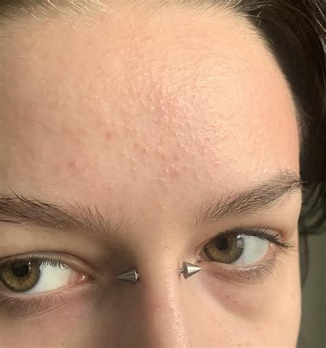 Sudden bumps appearing on forehead only? They appeared over the span of like a day and just keep ...