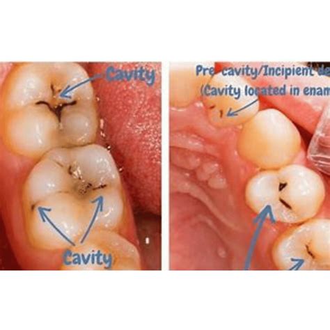 Cavity on Side of Tooth: What It Means and How to Treat It - Smile ...