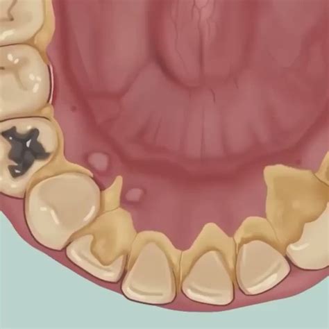 ¿Cómo quitar el sarro de los dientes de forma natural? - | Eliminar sarro dientes, Blanquear ...