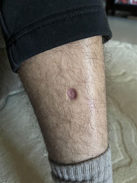 Hole in my brothers leg. What is it? : r/DermatologyQuestions