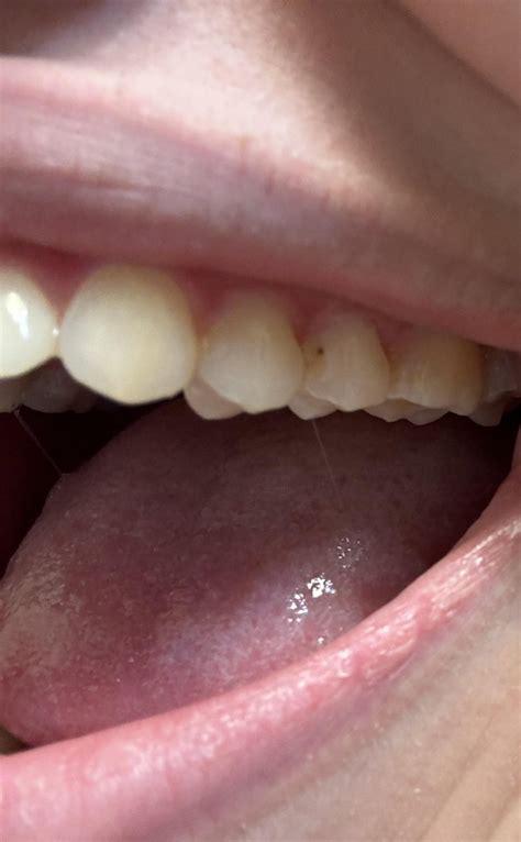 Small black spot on tooth. How bad does it seem? Cavity? Decay? stain? : r/askdentists