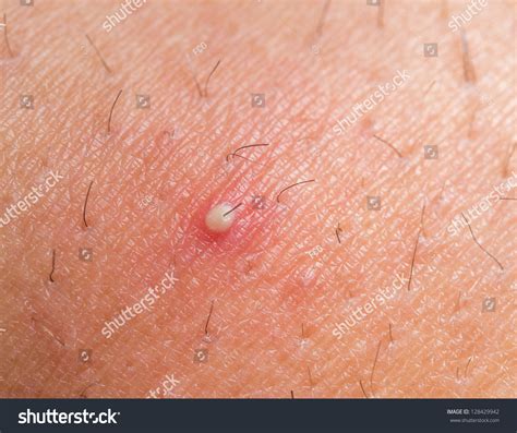 Ingrown Hair Testicles