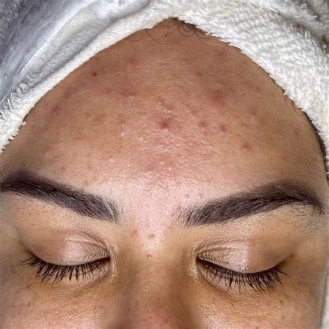 Blemishes on the face can have various causes. | by Lili.beauty | Medium