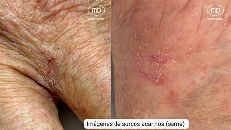 Sarna: Síntomas, Diagnóstico y Tratamiento - Blog naturabeauty