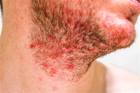 Why Do I Have a Rash on My Neck?
