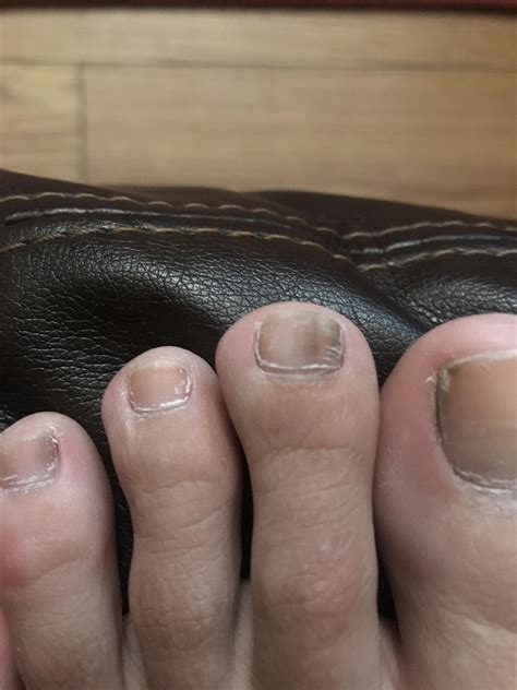 Why Are Some Of My Toenails Turning White at Victoria Nelson blog