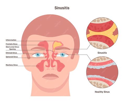 Premium Vector | Sinusitis Inflamed sinus with excess mucus and ...