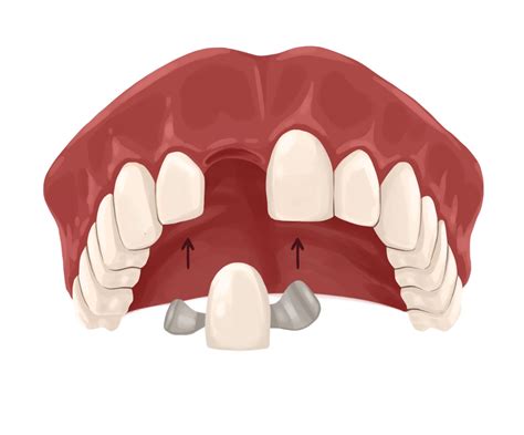 Dental bridge: types, and procedure | Authority Dental