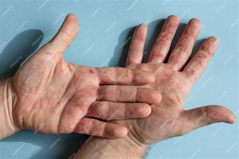 Rash On Palms Of Hands