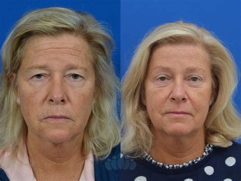 Brow Lift Before and After Pictures Case 71 | Charlotte, NC | Dilworth Facial Plastic Surgery