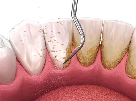 What Is Dental Scaling