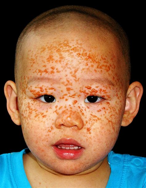 Multiple juvenile xanthogranulomas - The Journal of Pediatrics
