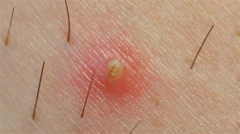 Understanding Cysts: Pilar, Sebaceous & Epidermoid - Beauty And Blog
