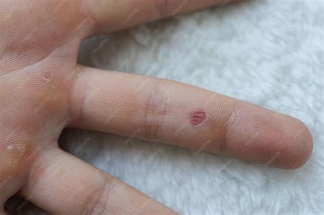 Premium Photo | A closeup of the calluses on the fingers of the palm of the hand hands blistered ...
