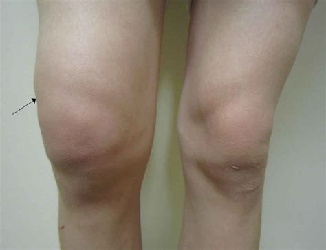 Knee effusion treatment - gilittechno