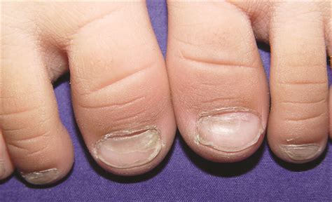 Onychomadesis Nail Changes Following Hand Foot Mouth Disease In North