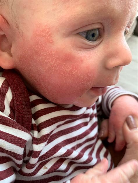 Hives On Babys Face