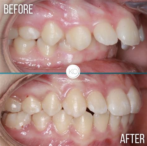 Discover How Braces Effectively Correct Overbites