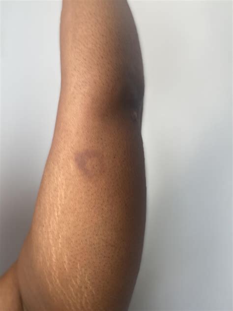 Does this look like a big bite (spider/tick), a bruise, or something else? : r/medical_advice