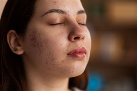 A new twist in the fight against acne