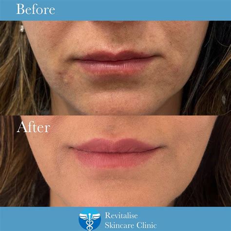 Botox lip flip treatment in Bath and Wiltshire - Revitalise Skincare Clinic