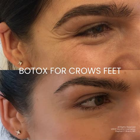 contact-us-thank-you - Verve Medical Cosmetics | Stephen Bracci, MD | Botox, Crows feet botox ...