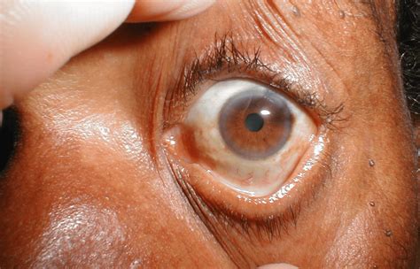 Why Is The White Part Of My Eye Turning Yellow at Rena Cooper blog
