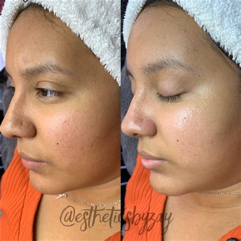 🤩Before/After Basic Facial w Extractions🤩 ...