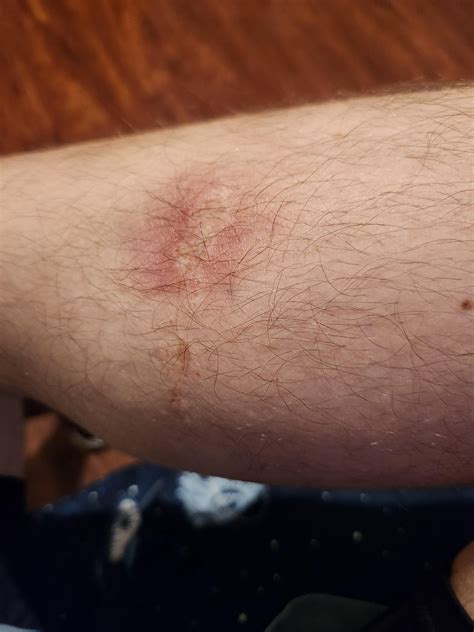 Cement Burns : r/Concrete