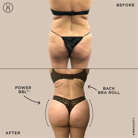 The Brazilian Butt Lift, Explained | AirSculpt