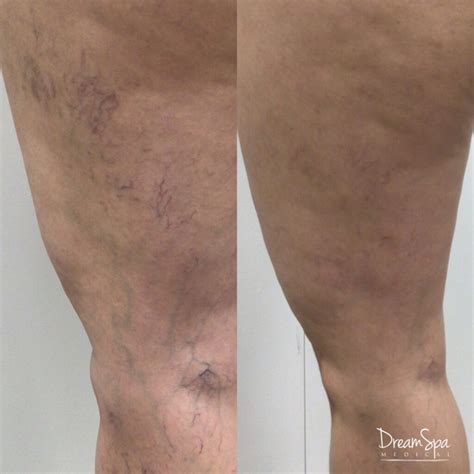 Sclerotherapy 1 - Dream Spa Medical