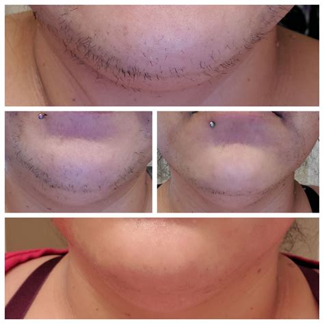 Pcos Facial Hair