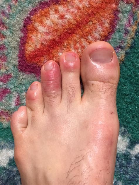 Scaly Blister Rash On Feet