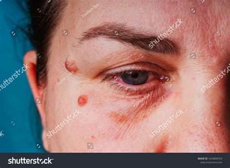 2,897 Melanoma Face Images, Stock Photos & Vectors | Shutterstock