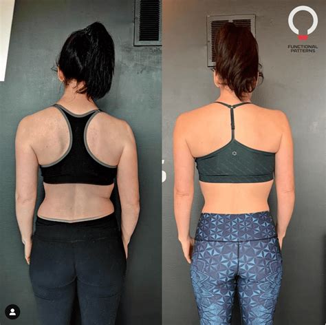 Thoracic Outlet Decompression - Surgery Vs Functional Movement ...