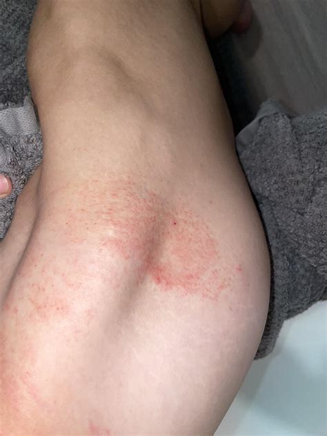 Does anyone know what this is? It's very itchy and dry and has been ...