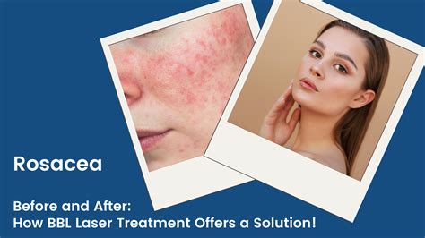 BBL Laser Treatment for Rosacea