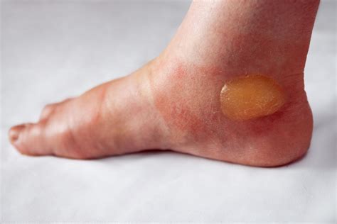 Foot Blisters Treatment | By Steady Gait Foot Clinic in Scarborough