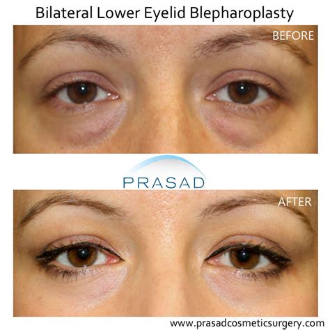 Under Eye Bags Plastic Surgery Before And After at Ella Hogarth blog