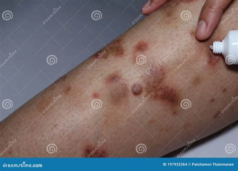 Legs of a Patient with Psoriasis are Chronic Autoimmune Dermatitis, a Health Care Concept in ...