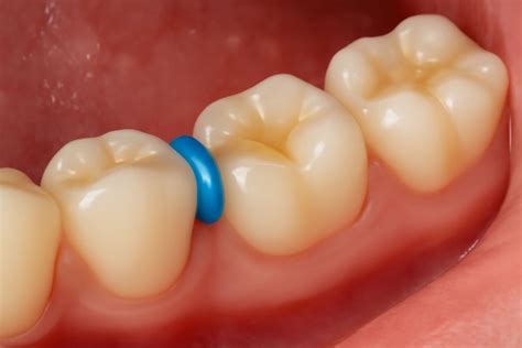 ¿Qué hace un separador para los dientes? | Lema Dental Clinic