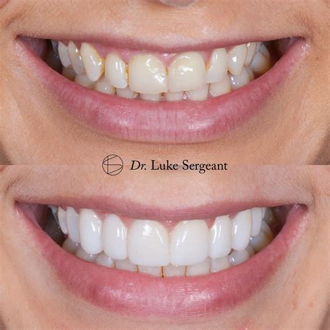 All about Composite Bonding — Raby Road Dental