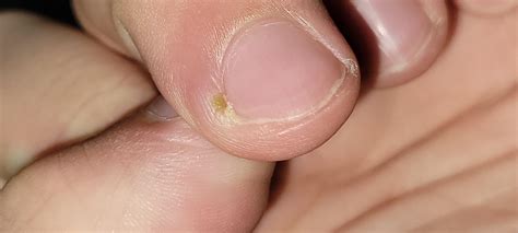 Green Around Fingernail at Stephanie Felder blog