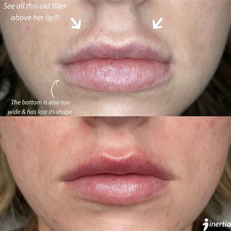 Lip Filler Dissolved